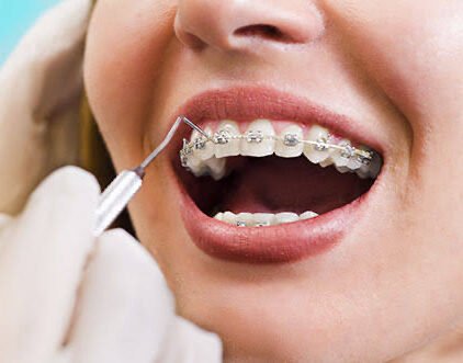 Dental Orthodontics / Braces