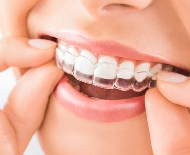 Clear Aligners Treatment