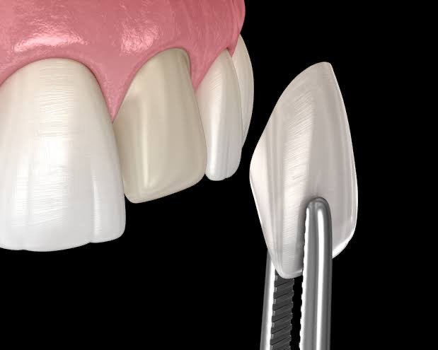 Dental Veneers & Crowns