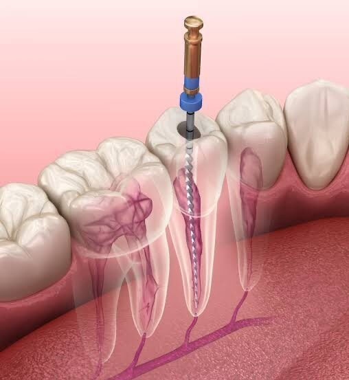 Root Canal Treatment