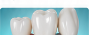 Dental Veneers & Crowns
