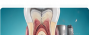 Root Canal Treatment
